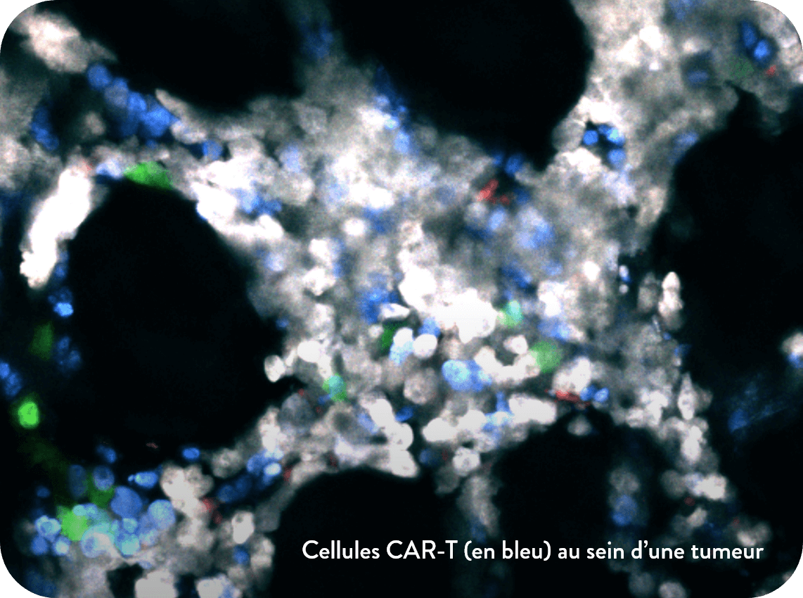 Cellules CAR-T (en bleu) au sein d’une tumeur