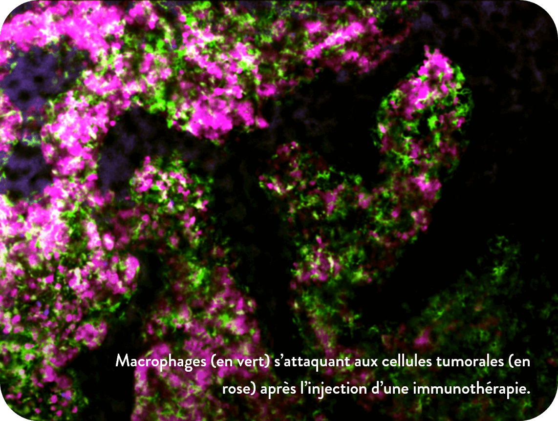 Macrophages (en vert) s’attaquant aux cellules tumorales (en rose) après l’injection d’une immunothérapie.