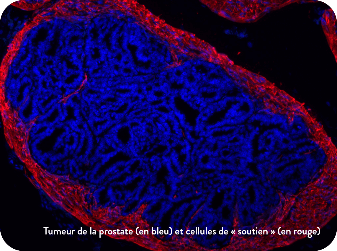 Tumeur de la prostate (en bleu) et cellules de « soutien » (en rouge)