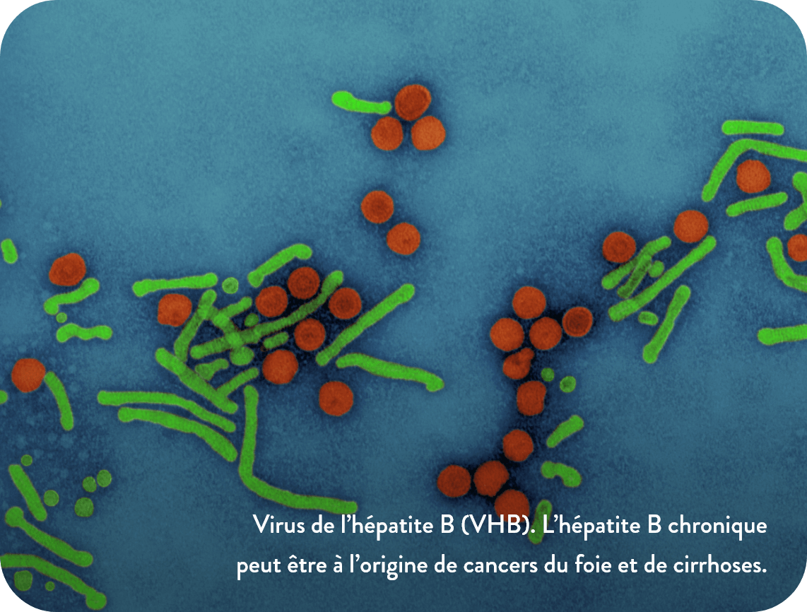 Virus de l’hépatite B (VHB). L’hépatite B chronique peut être à l’origine de cancer du foie et de cirrhose.